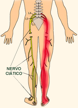 Tratamento da dor no nervo ciático com Quiropraxia 1